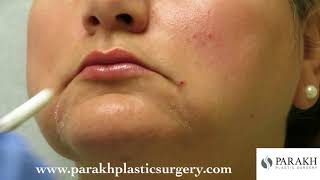 Dr Parakh  BOTOX Injection to the DAO muscle Corner of Mouth [upl. by Akienat]