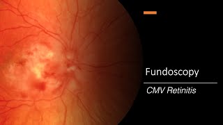 CMV Retinitis Fundoscopy [upl. by Dre879]